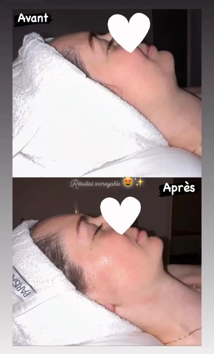 Avant et après drainage lympathique visage