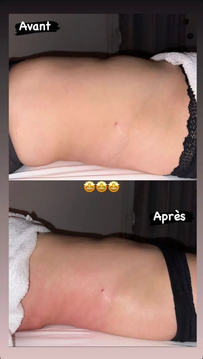 Avant et après drainage lympathique ventre et hanches